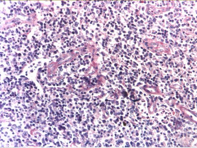 Fig.5: TCRBCL. H-E - <div style=